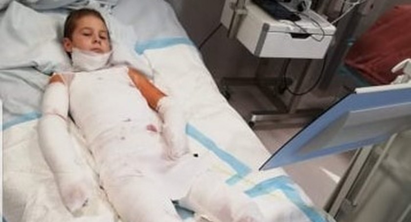 Zdjęcie ciężko poparzonego 9-letniego Oskara ze Skarżyska-Kamiennej